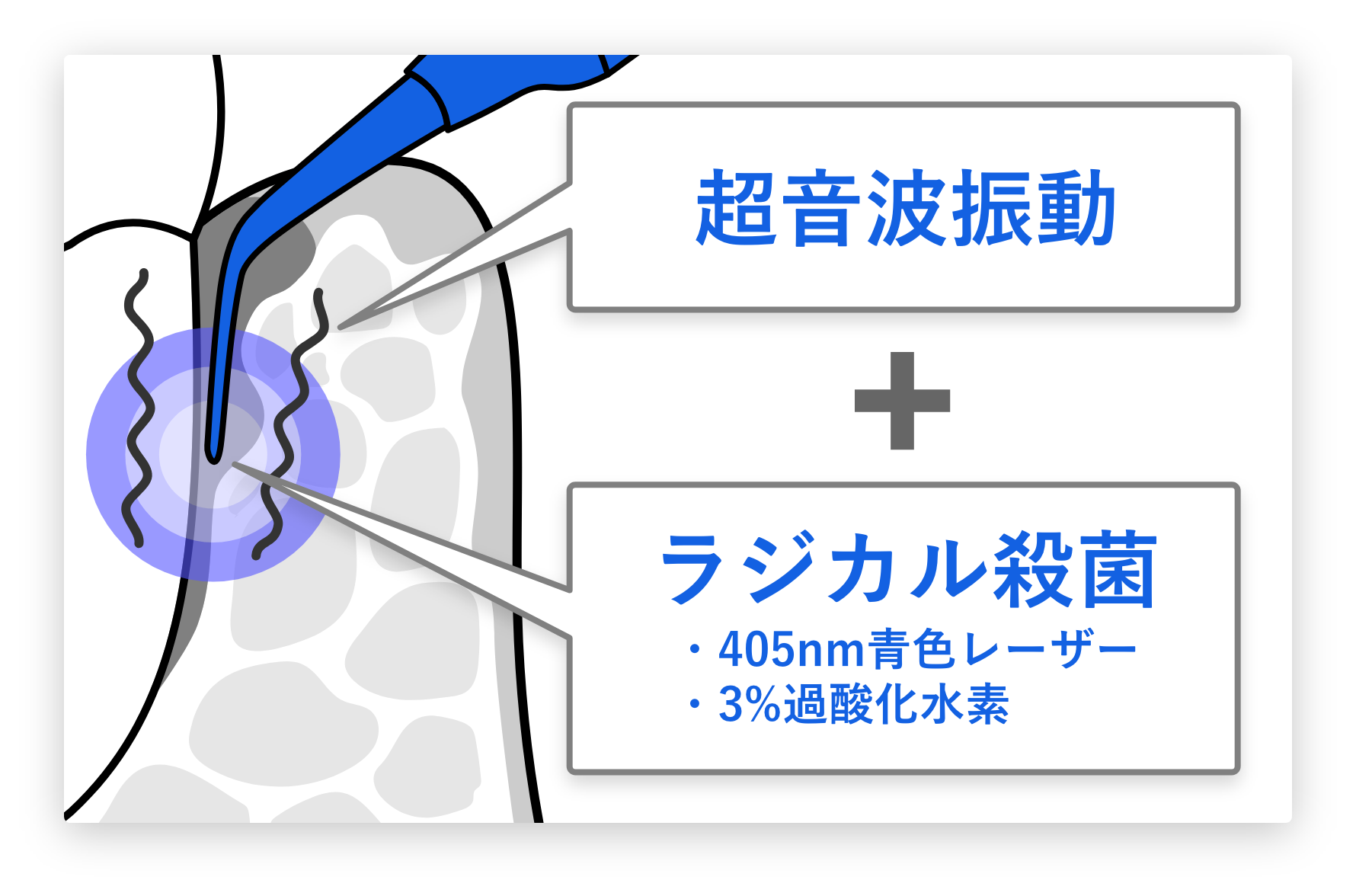 ブルーラジカルの超音波振動とラジカル殺菌の仕組み